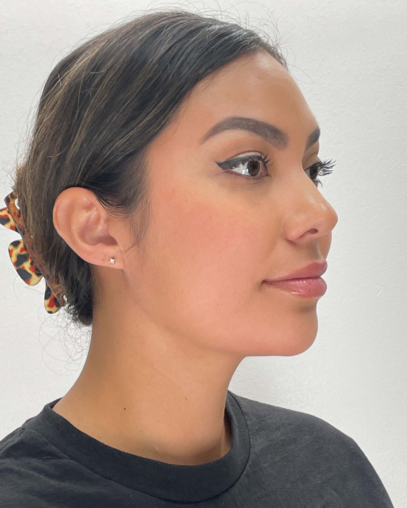 Renuvion Before & After Image