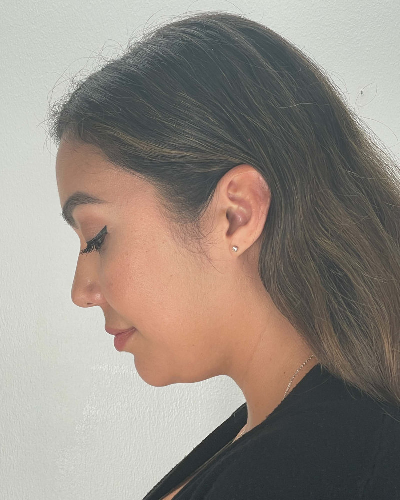 Renuvion Before & After Image