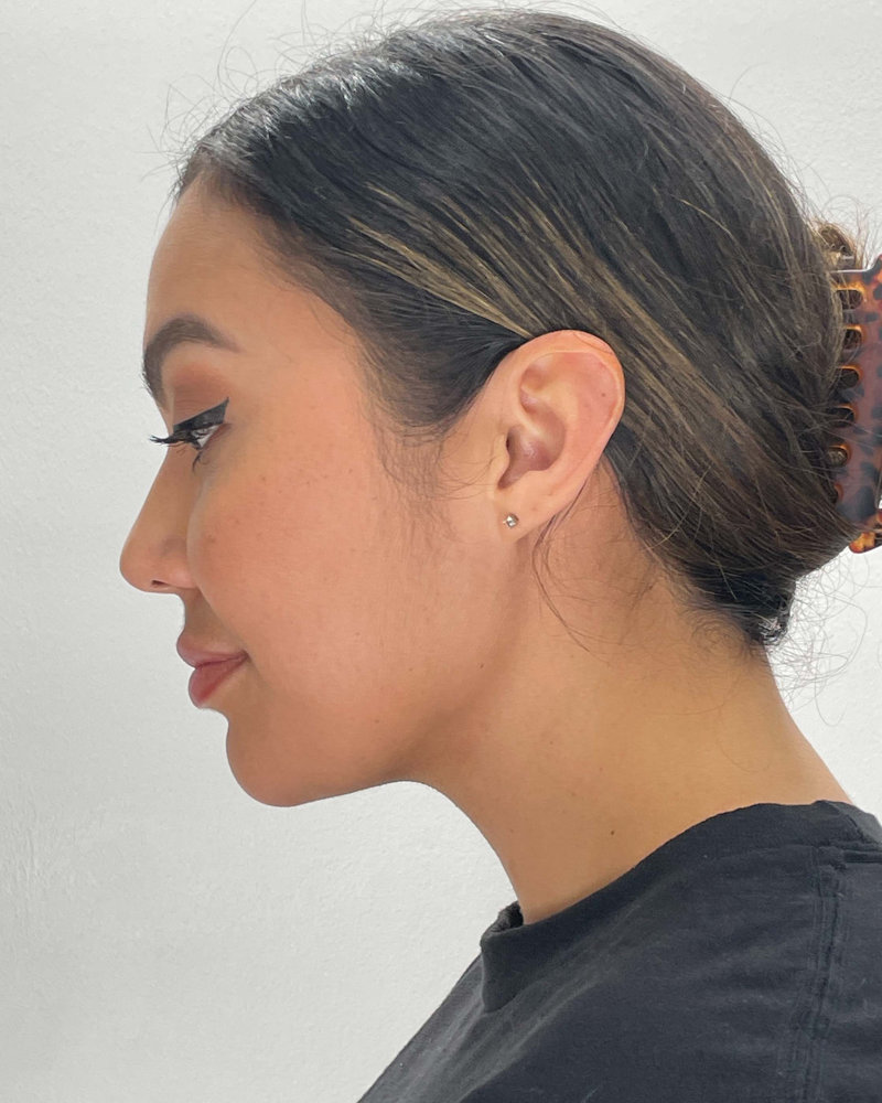 Renuvion Before & After Image