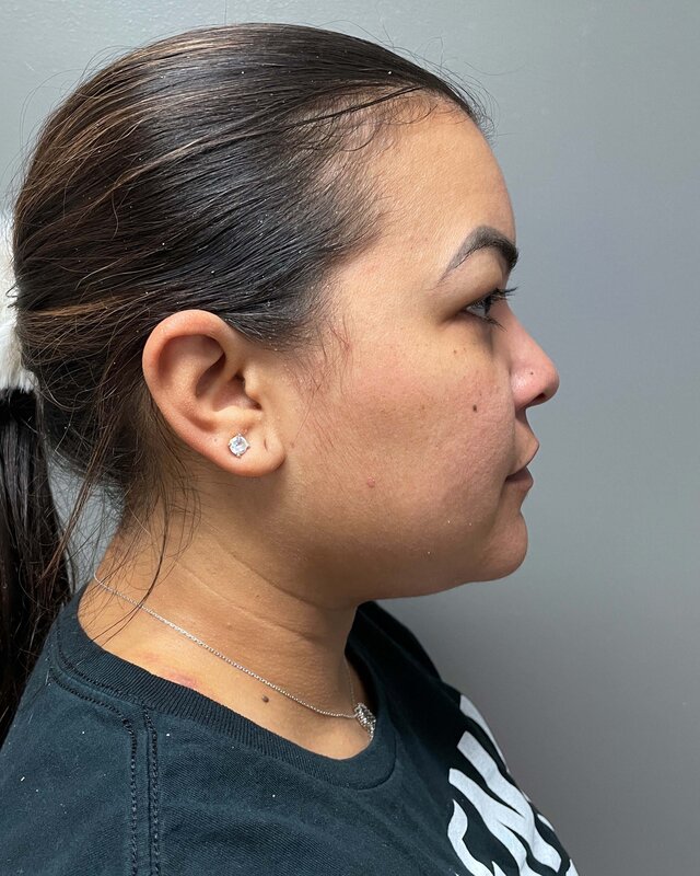 Renuvion Before & After Image