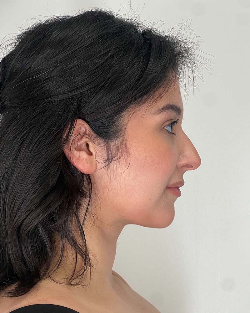 Renuvion Before & After Image