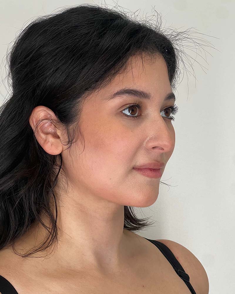 Renuvion Before & After Image