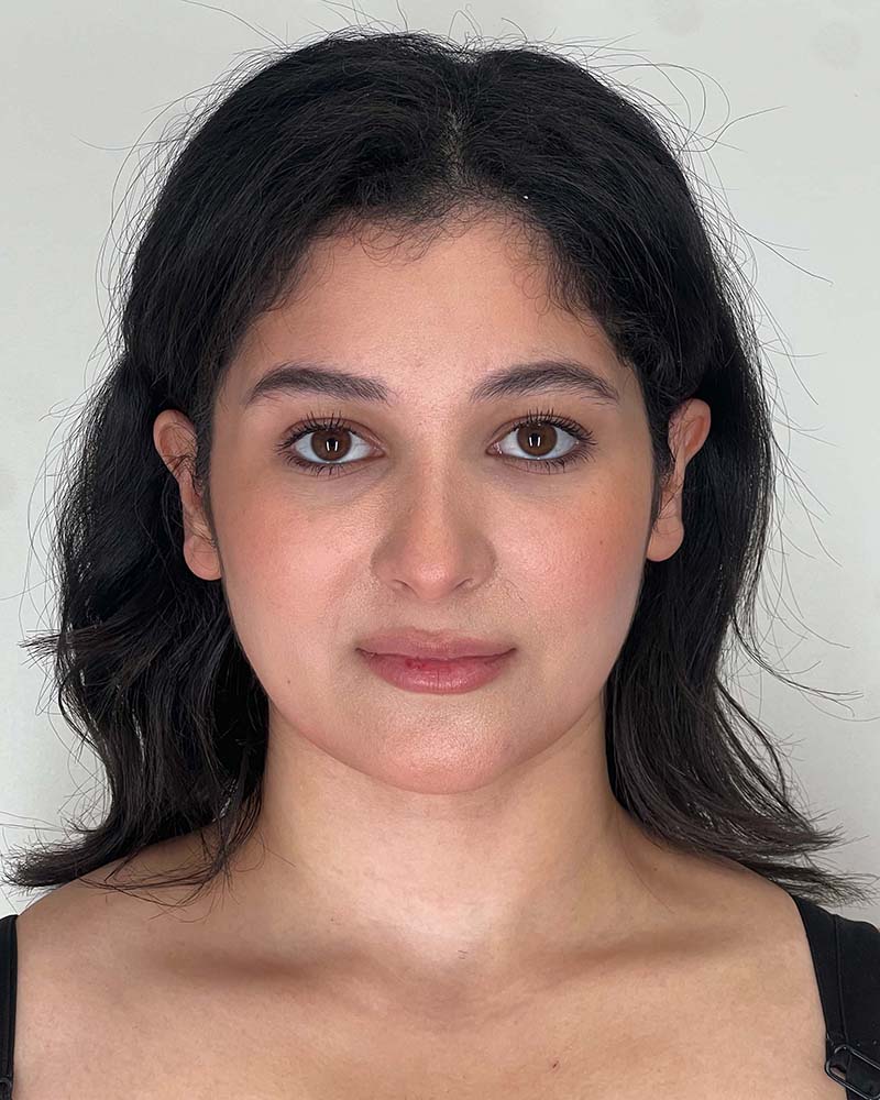 Renuvion Before & After Image