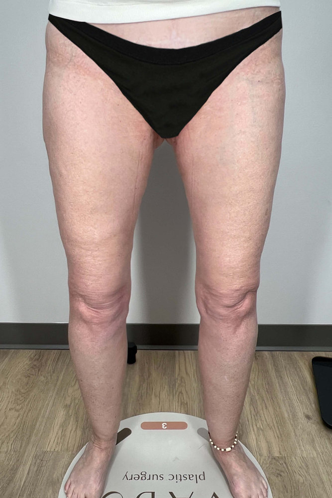 Thigh Lift Before & After Image