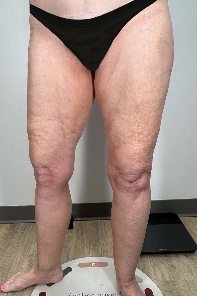 Thigh Lift Before & After Image