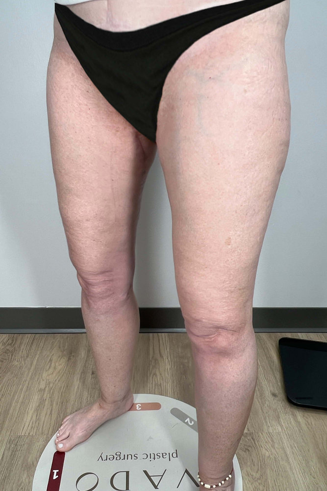 Thigh Lift Before & After Image