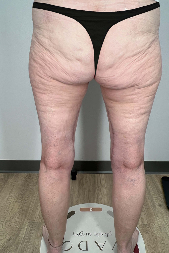Thigh Lift Before & After Image