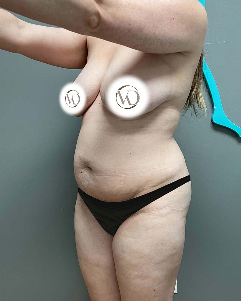 Tummy Tuck Before & After Image