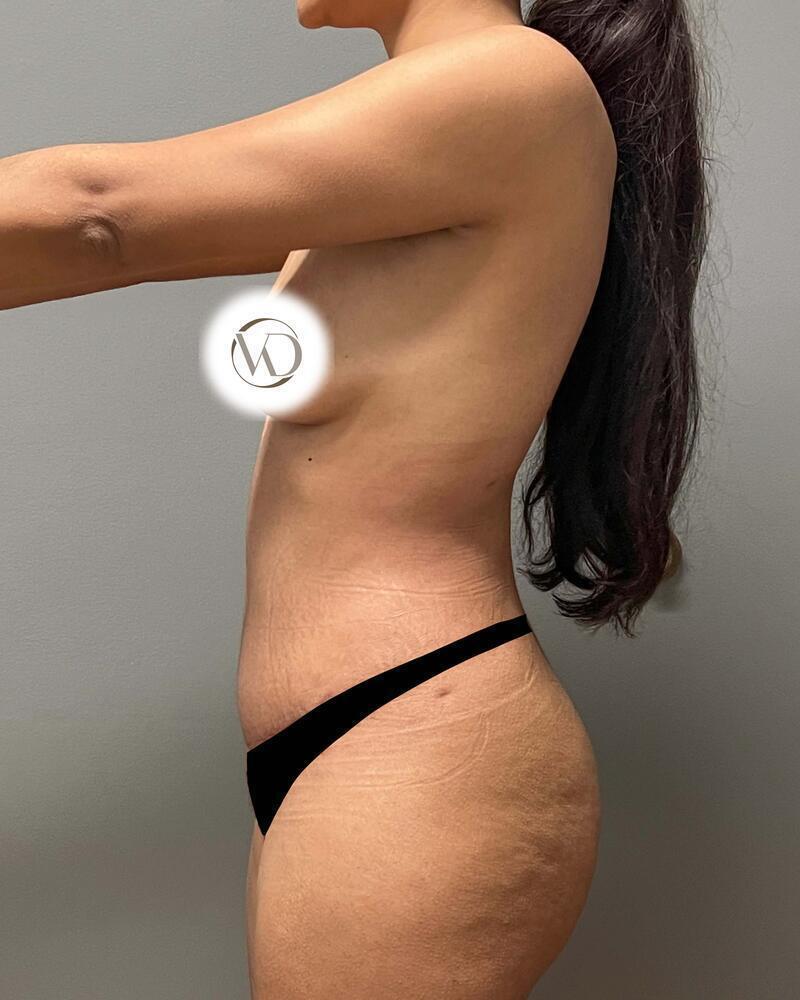 Tummy Tuck Before & After Image