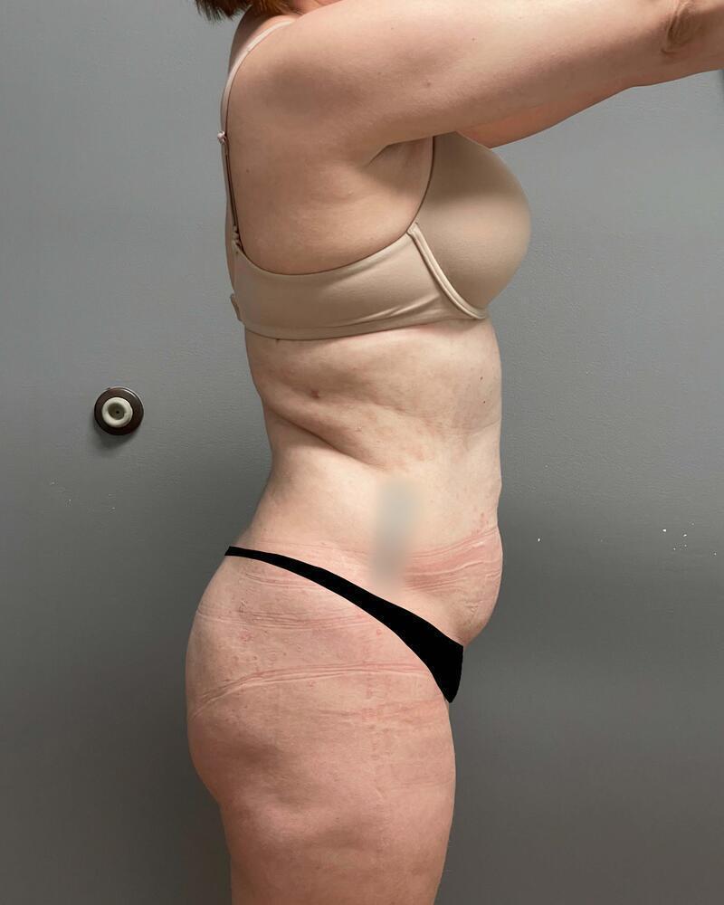 Tummy Tuck Before & After Image