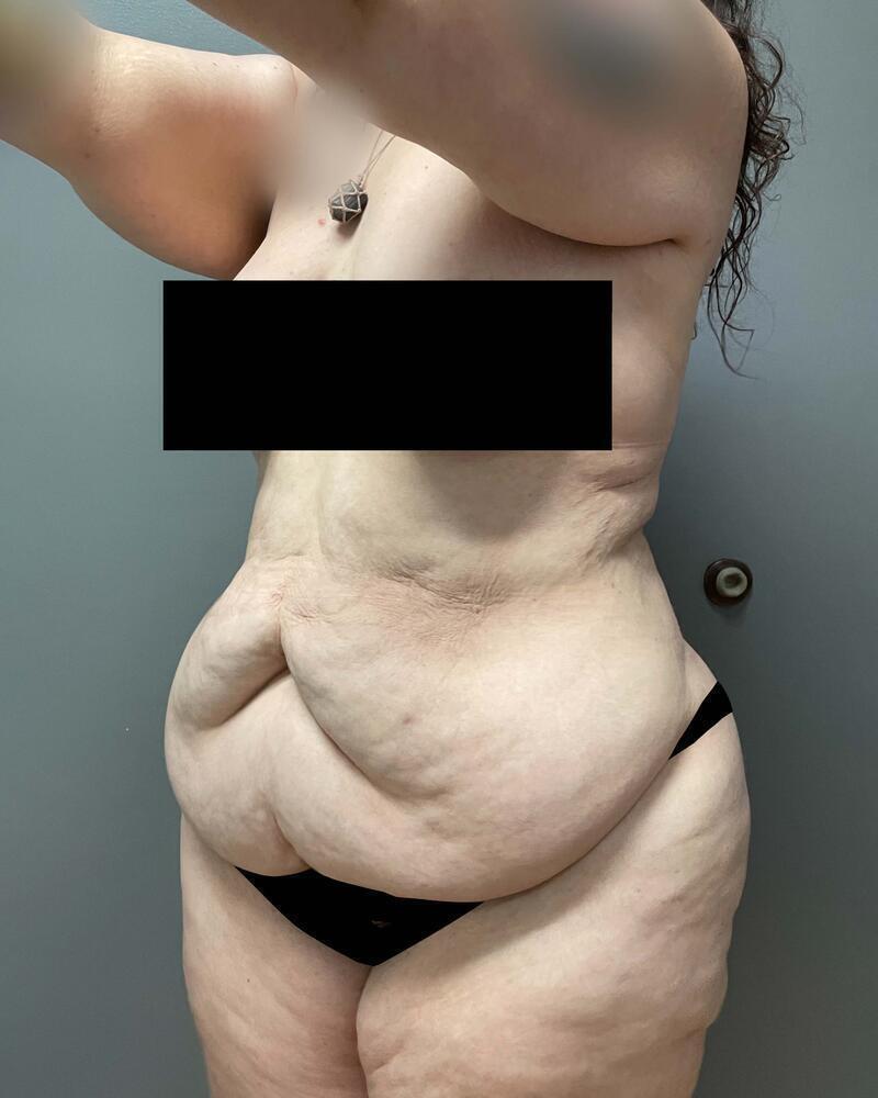Tummy Tuck Before & After Image
