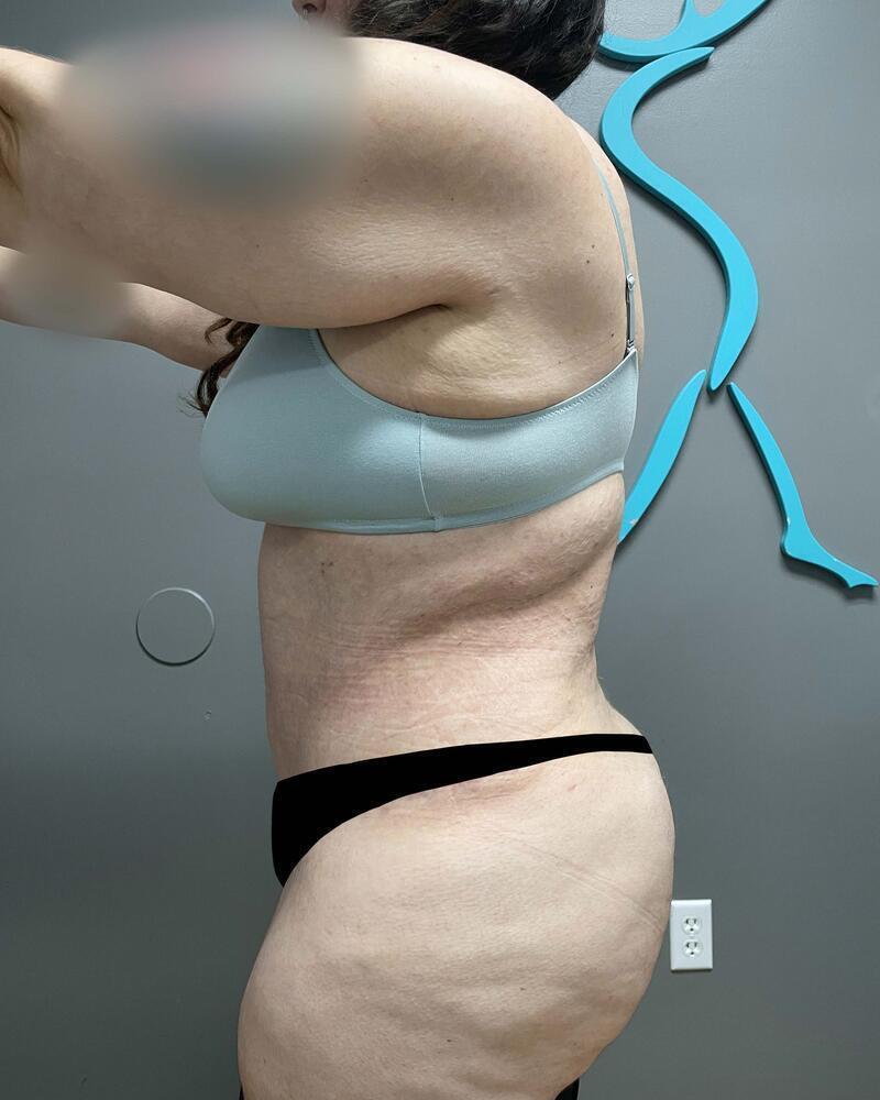 Tummy Tuck Before & After Image