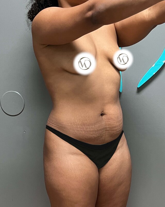 Tummy Tuck Before & After Image