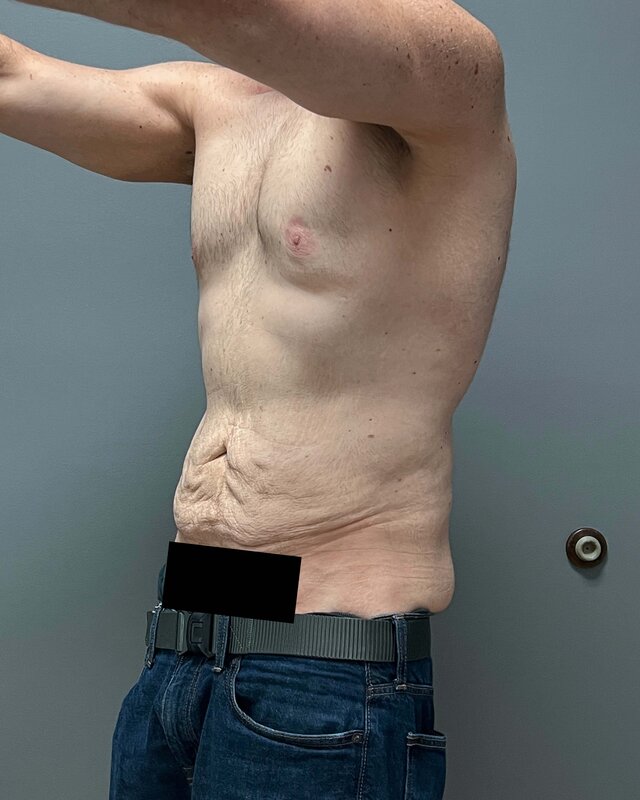 Tummy Tuck Before & After Image