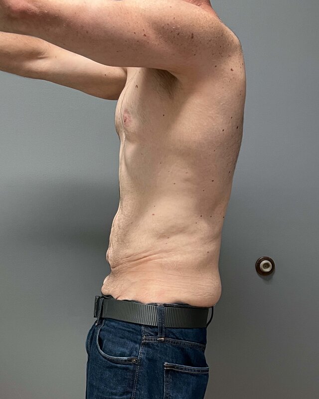 Tummy Tuck Before & After Image