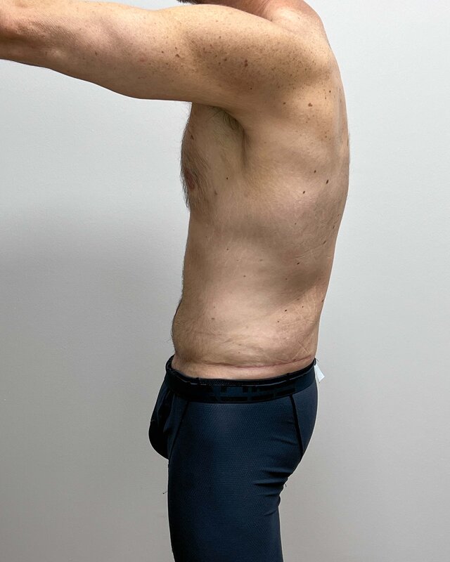 Tummy Tuck Before & After Image