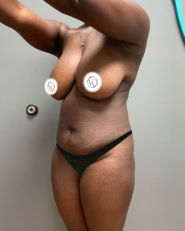 Tummy Tuck Before & After Image