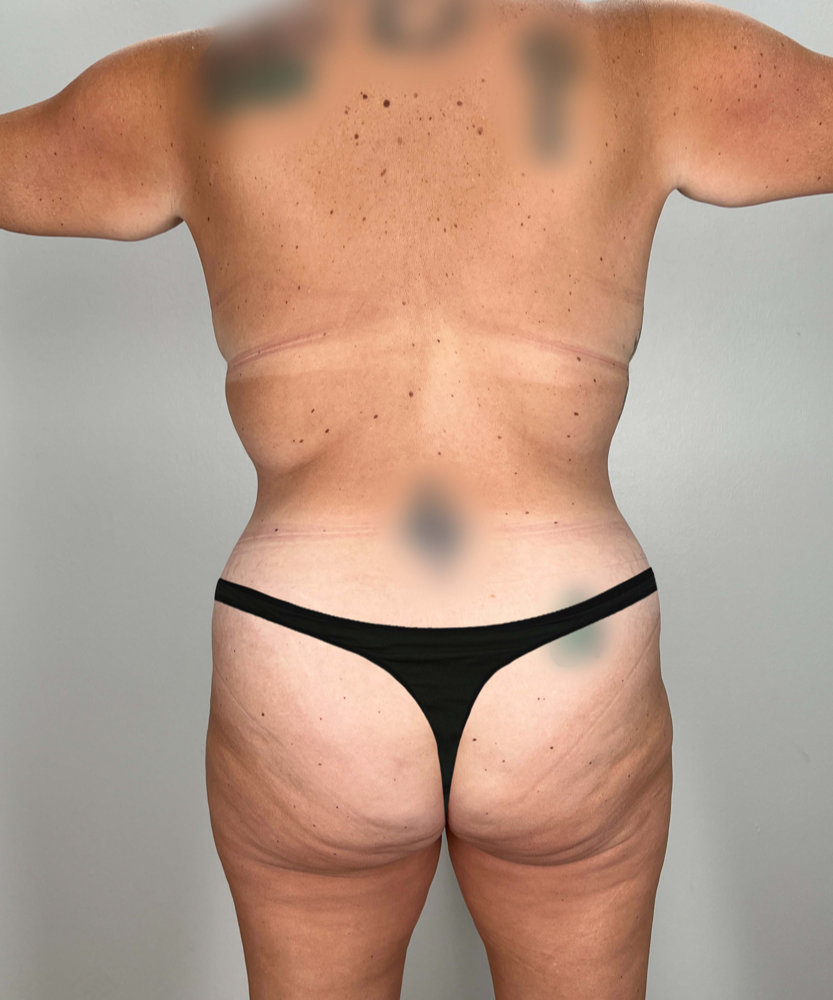 Tummy Tuck Before & After Image