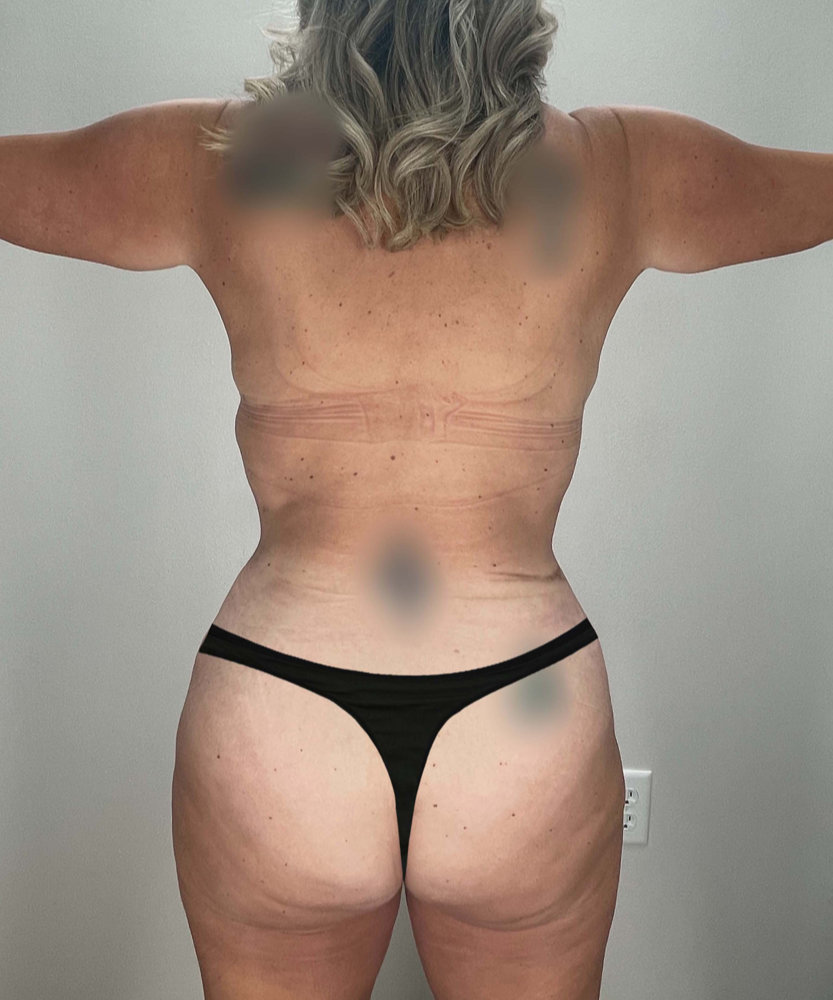 Tummy Tuck Before & After Image