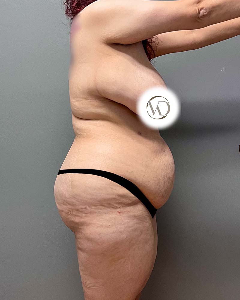 Tummy Tuck Before & After Image