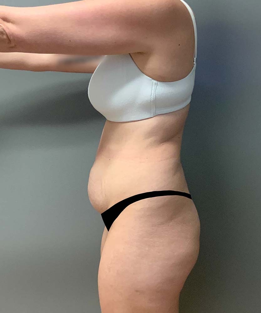 Tummy Tuck Before & After Image
