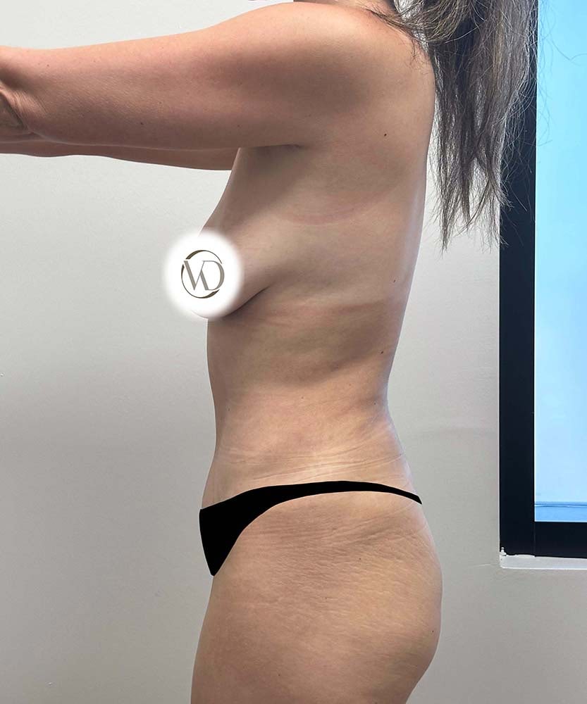 Tummy Tuck Before & After Image