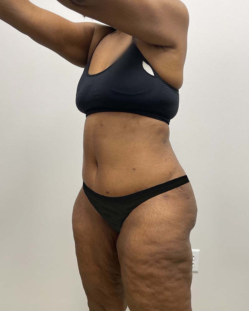 Tummy Tuck Before & After Image