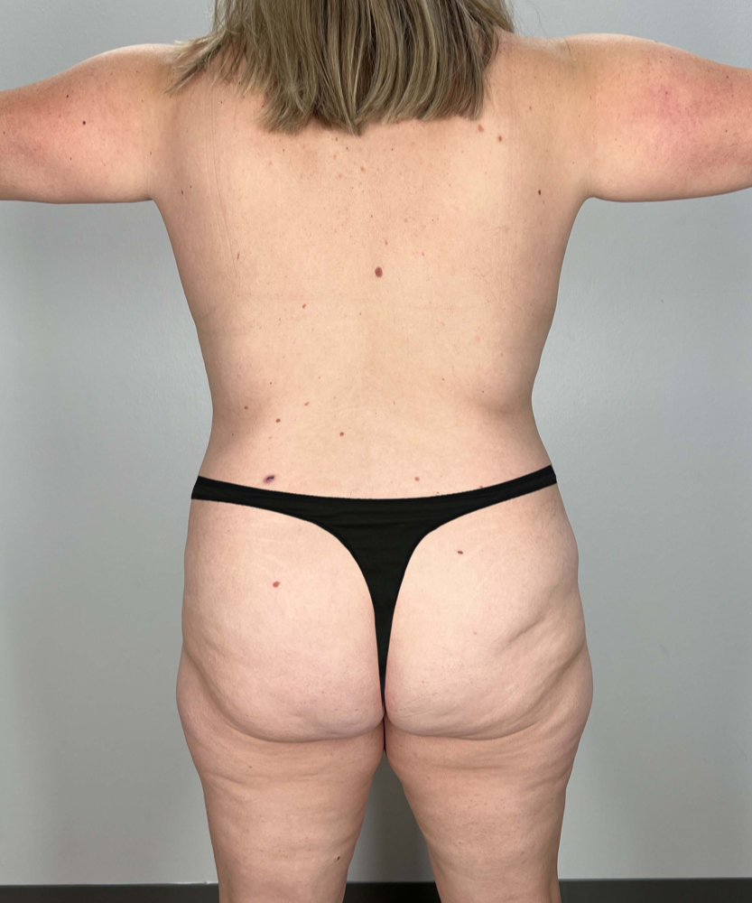 Tummy Tuck Before & After Image