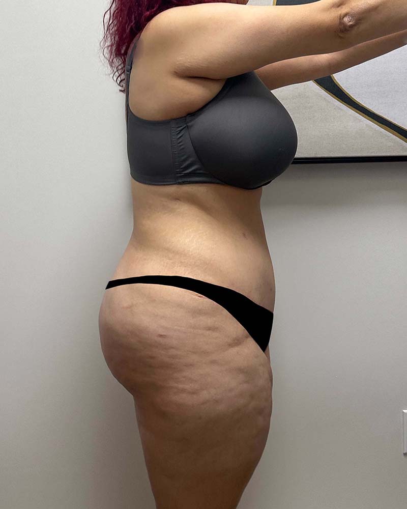 Tummy Tuck Before & After Image