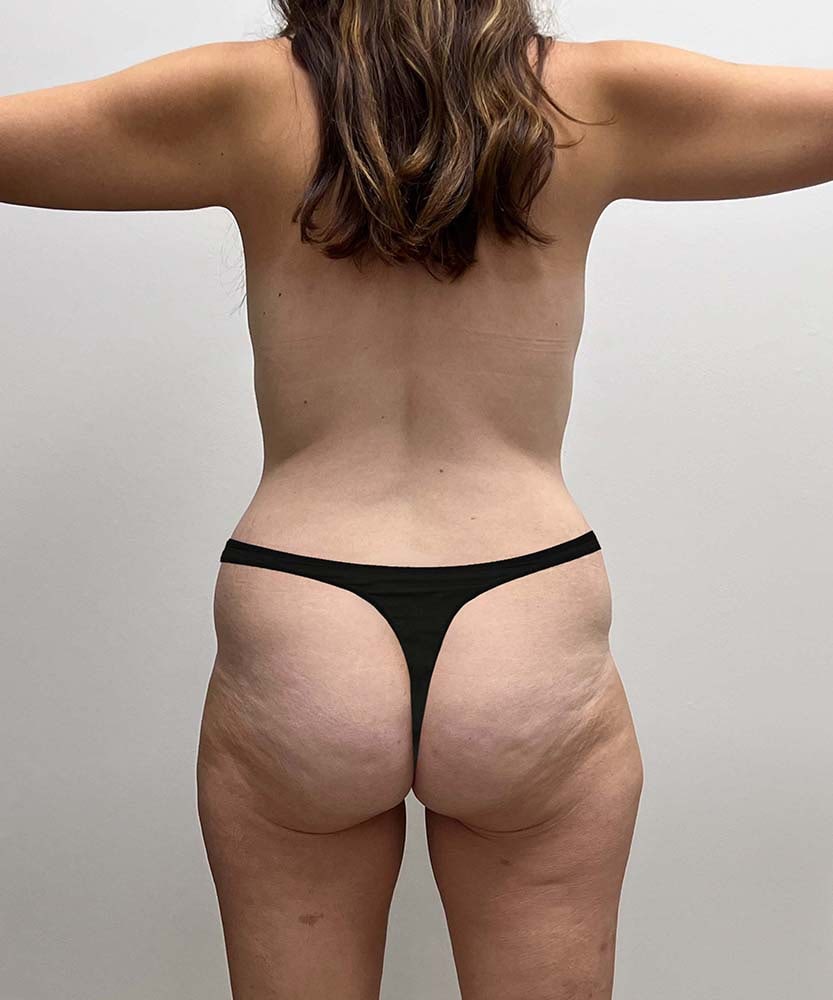 Tummy Tuck Before & After Image