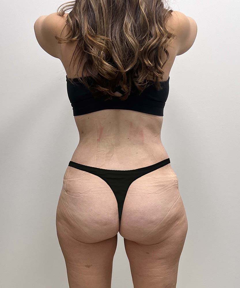 Tummy Tuck Before & After Image