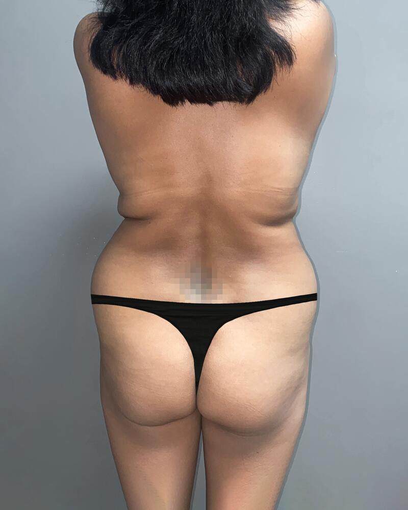 Tummy Tuck Before & After Image