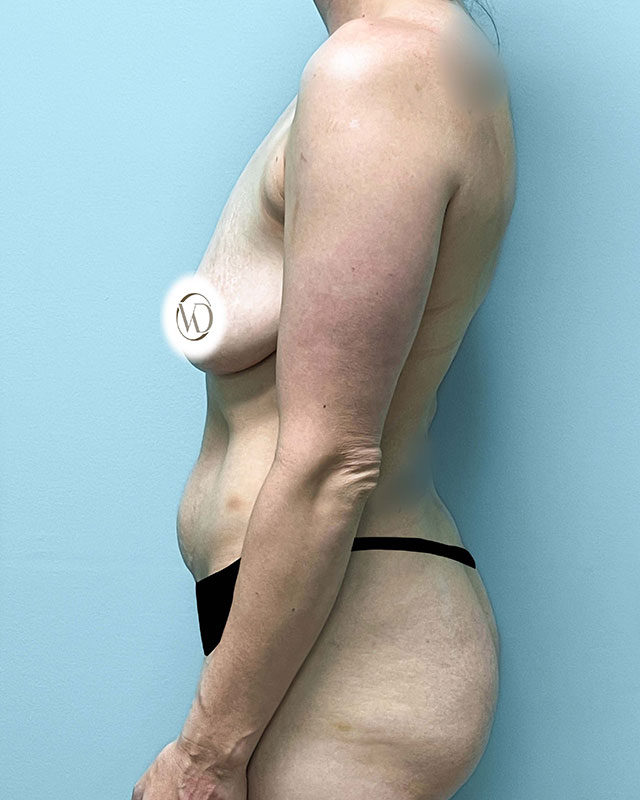 Tummy Tuck Before & After Image