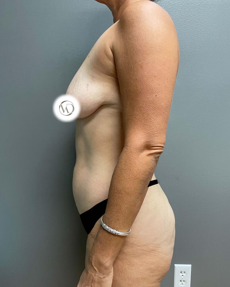 Tummy Tuck Before & After Image