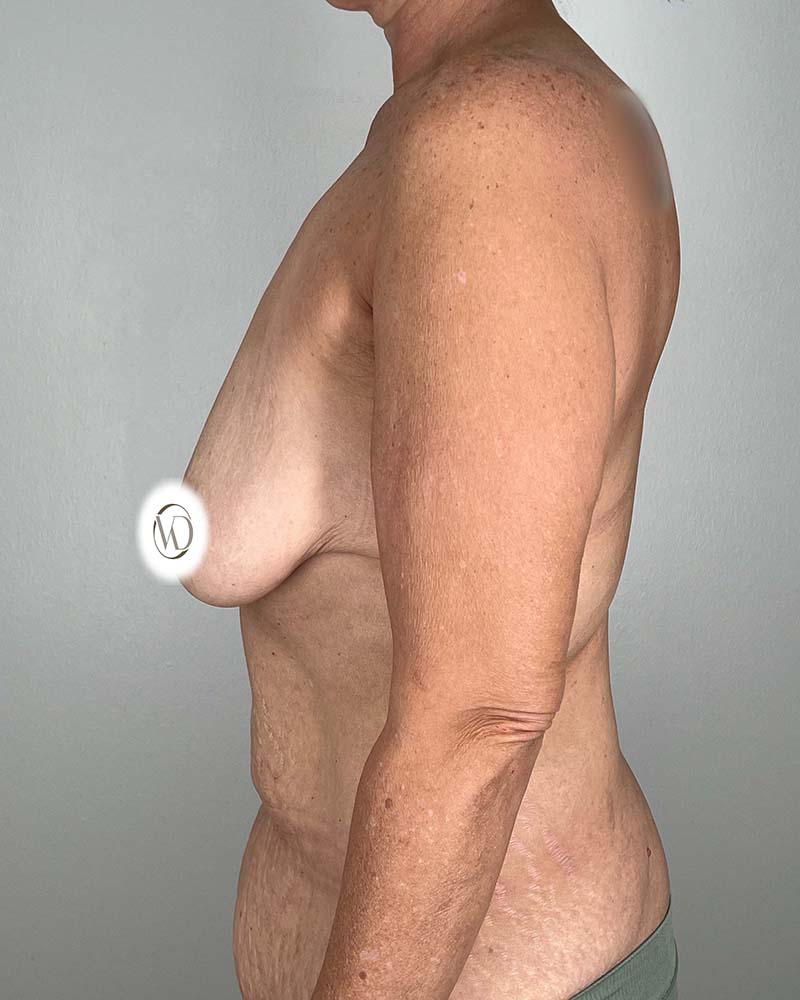 Tummy Tuck Before & After Image