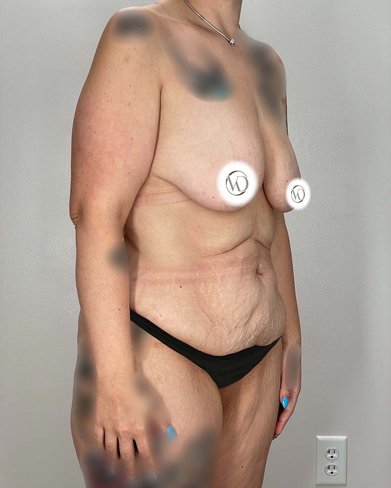 Tummy Tuck Before & After Image