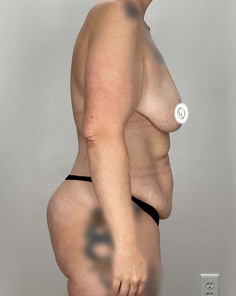 Tummy Tuck Before & After Image