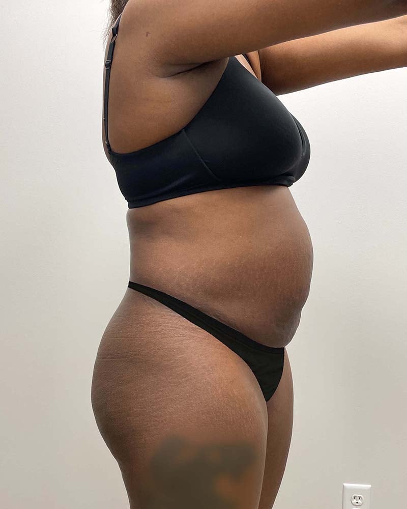 Tummy Tuck Before & After Image