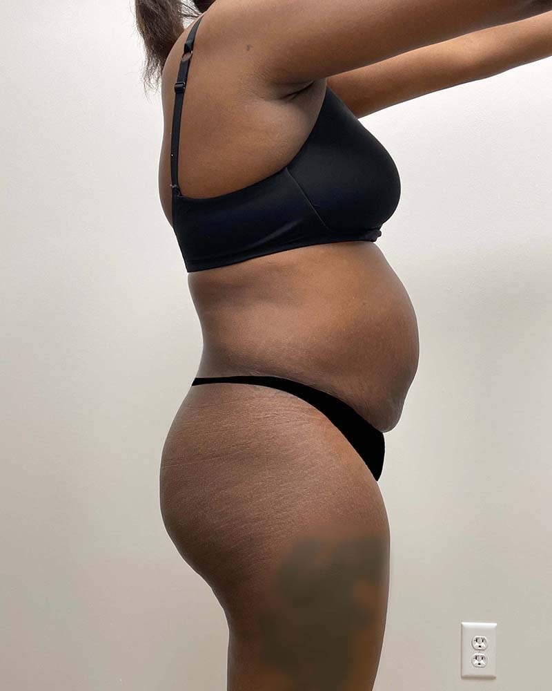 Tummy Tuck Before & After Image