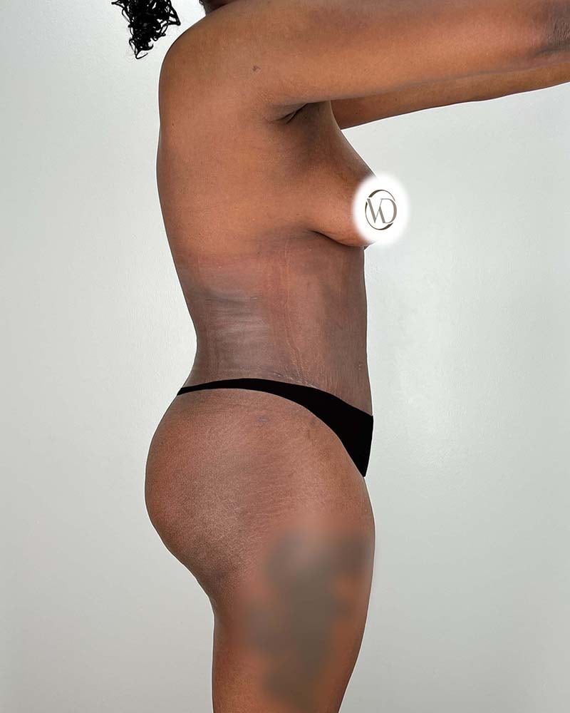 Tummy Tuck Before & After Image