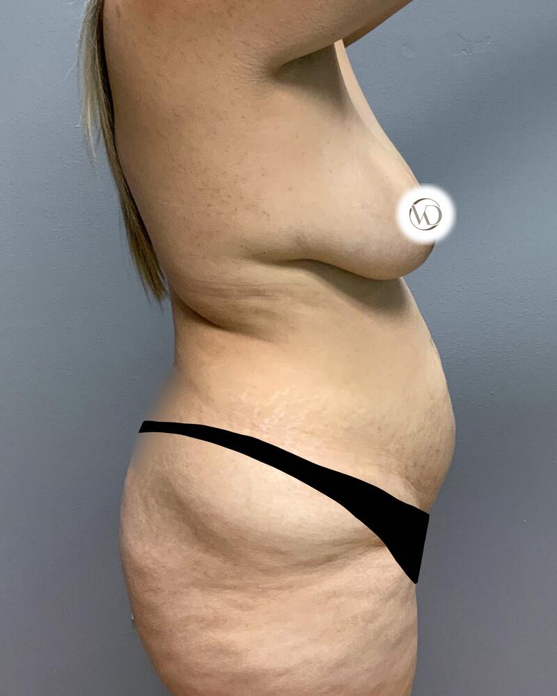 Tummy Tuck Before & After Image