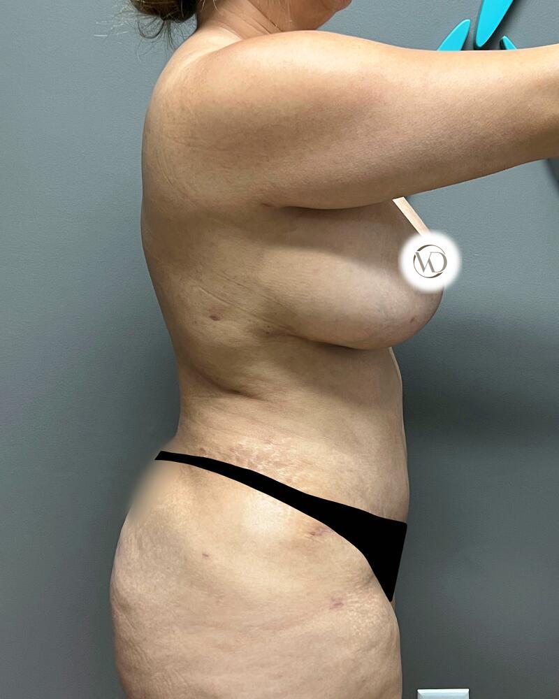 Tummy Tuck Before & After Image