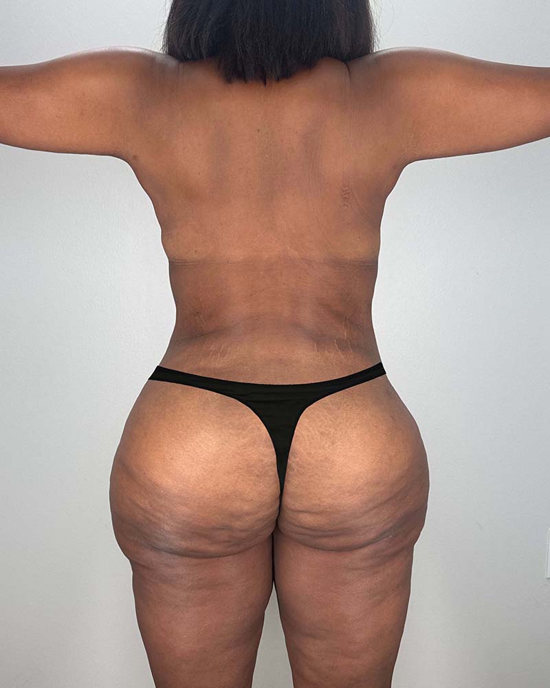 Tummy Tuck Before & After Image