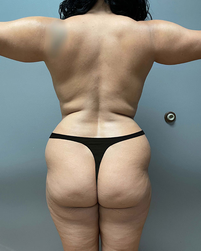 Tummy Tuck Before & After Image