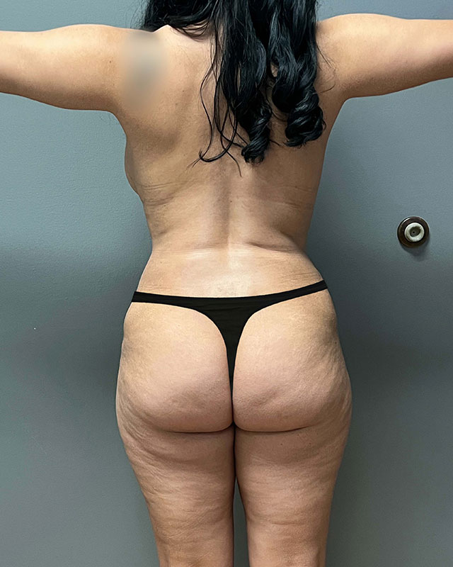 Tummy Tuck Before & After Image