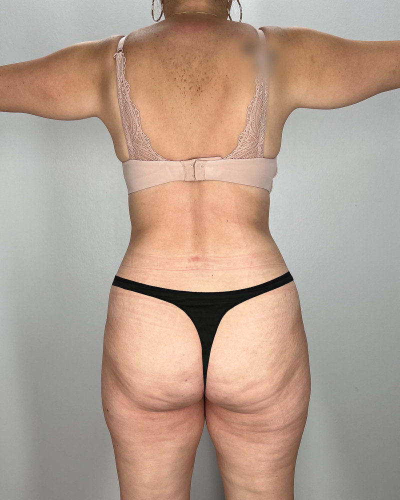 Tummy Tuck Before & After Image