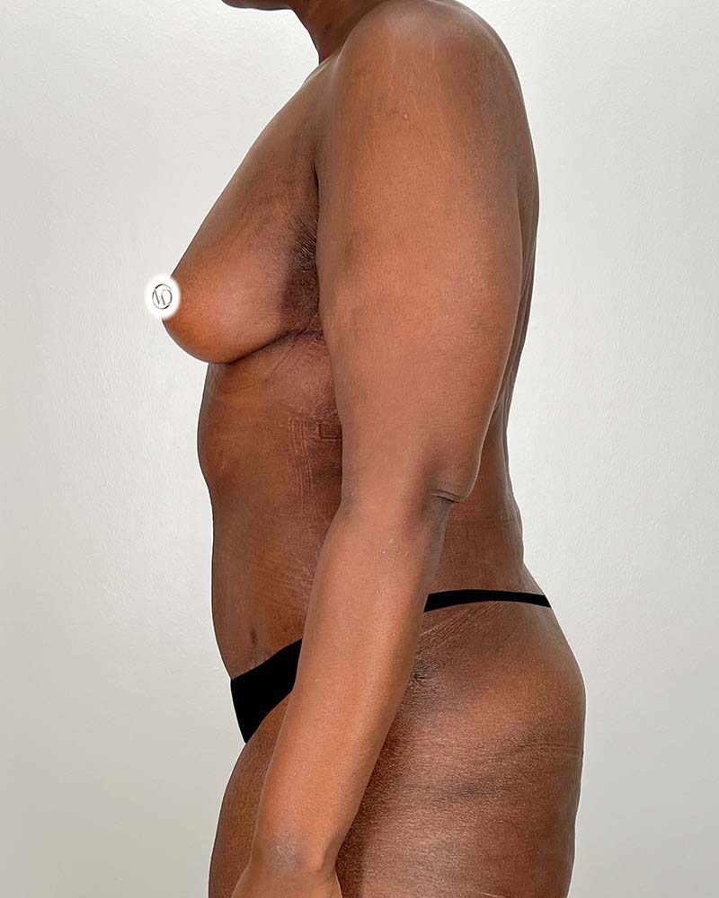 Tummy Tuck Before & After Image