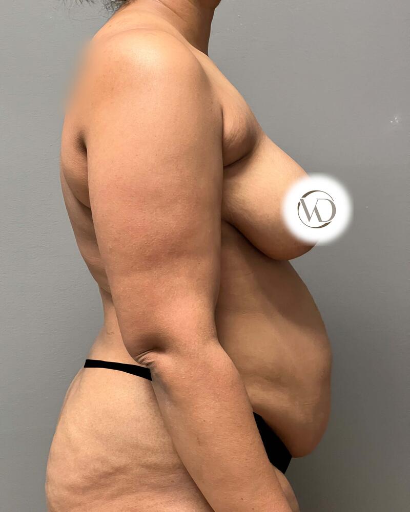 Tummy Tuck Before & After Image