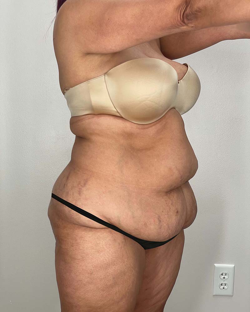 Tummy Tuck Before & After Image