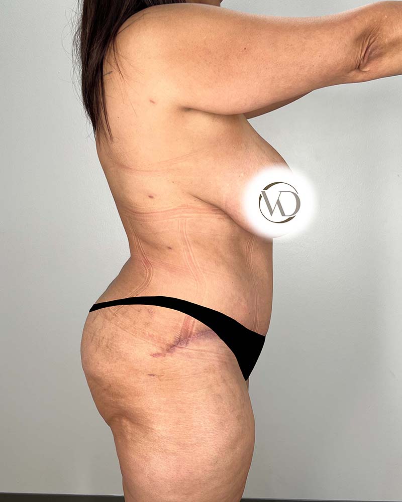 Tummy Tuck Before & After Image